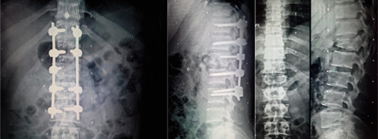 Brust Fracture